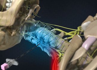 Nokta Atışı ( Epidural Enjeksiyon ) Tedavisi epidural enjeksiyon